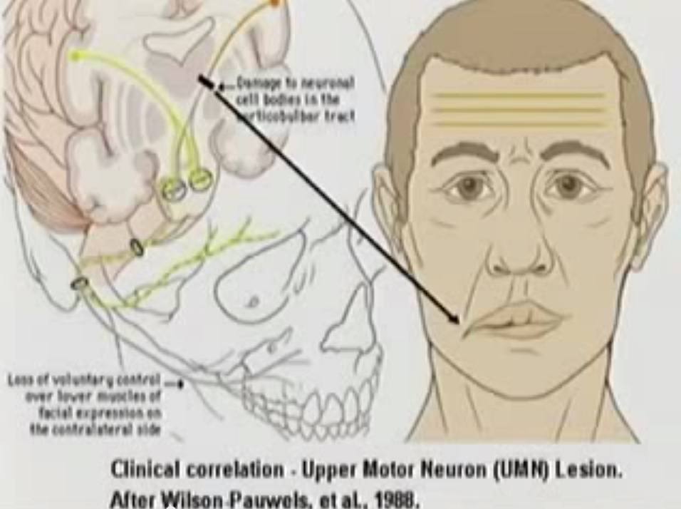 Cranial nerve damage, mouth drooping, stroke