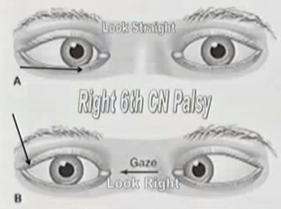 palsy-eye-muscles